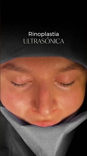 Rinoplastia Ultrasónica: Técnica Precisa, Menos Inflamación y Resultados Naturales
