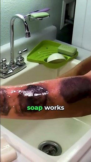 How to never get a serious Poison Ivy Rash again 🌿