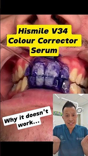 HiSmile Disappointment: Why It Falls Short #shorts #dentallan #dentist