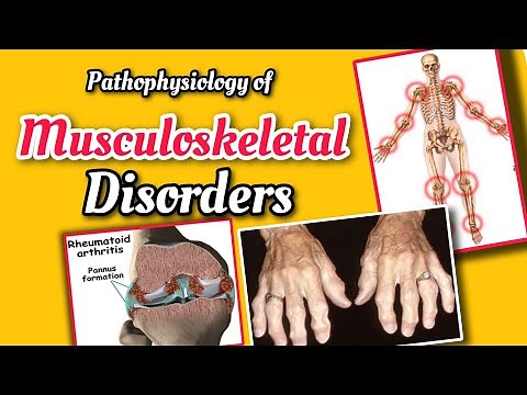 The Pathophysiology of Musculoskeletal Skeletal disorders | Osteoarthritis, Osteoporosis, Rheumatoid