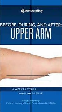 CoolSculpting Before and After - CoolSculpting Results