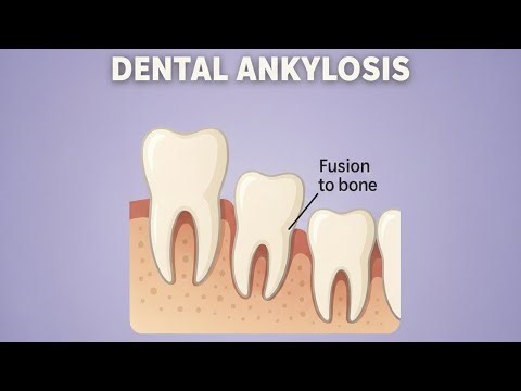 DENTAL ANKYLOSIS