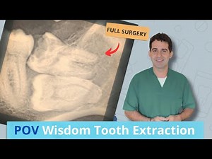POV Wisdom Tooth Extraction | Full Surgery EXPLAINED