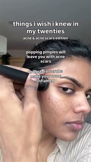 Dropping some golden tips I wish I knew in my 20s. This would've made it easier #acne #acnescars