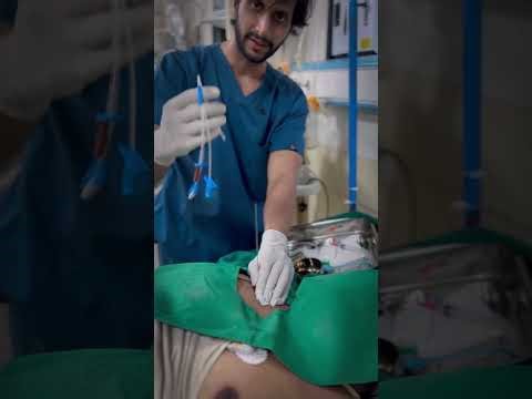 Subclavian central line blind insertion in the first prick