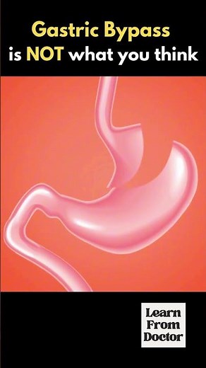 Gastric Bypass Surgery Explained Simply | What Actually Changes Inside