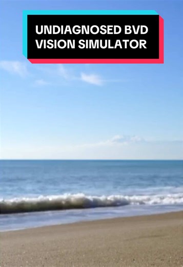 Understanding Binocular Vision Dysfunction at the Beach