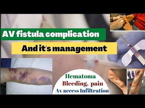 AV fistula/avf Cannulation complication and management/hematoma/bleeding/pain/stenosis/aneurysm