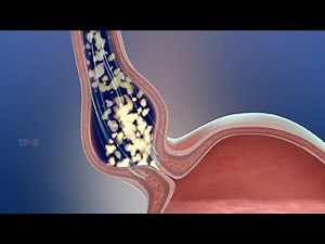 Achalasia Dilation: Indications, Preparation, Procedure, Risks and Complications
