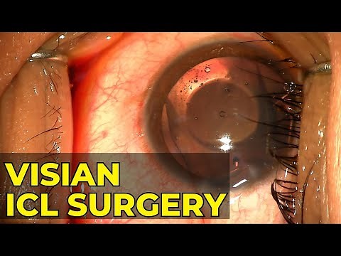 Live Staar Visian ICL Surgery Video I ICL Surgery Procedure