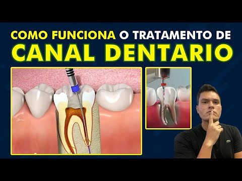 COMO FUNCIONA O TRATAMENTO DE CANAL DENTÁRIO | PASSO A PASSO RESUMIDO.