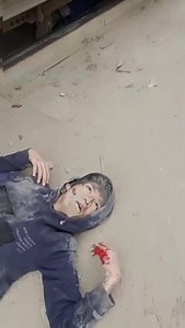 Barely Alive After Cut In Half By Train