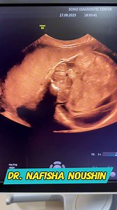 Anomaly scan - Macrocephaly with a brain tumour #drnafisha #anomalyscan #pregnancy #PostViral #macrocephaly | Dr. Nafisha Noushin