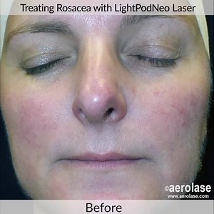 🔴 ROSACEA 💥 #LightPodNeo laser treats #rosacea in ONE to TWO quick, gentle treatments without skin contact or cooling. 📷 photos courtesy of Pinski Dermatology & Cosmetic Surgery, S.C. in #Chicago | Aerolase