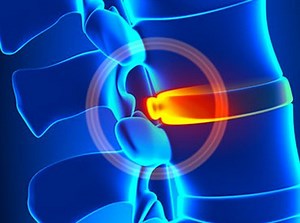 Spinal Stenosis Pain | Carolinas Pain Center
