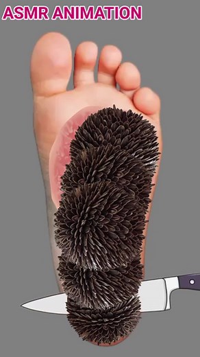 ASMR Animation TREATMENT | Remove worm, maggots, dog tick, spider, bees, wasp from Foot, feet, legs | Deep Cleaning Animation | 2D Animation | foot care | feet care asmr, asmr treatment, brain asmr, braini asmr asmr mouth sounds, asmr videos, asmr animation, asmr sleep, asmr satisfaction, asmr stop motion, asmr ear cleaning treatment, rest asmr, asmr mukbang, asmr video, asmr make up, asmr care, animation, 2d animation, stop motion, maggot remove, rainbow asmr, relaxing asmr, dog tick animation,