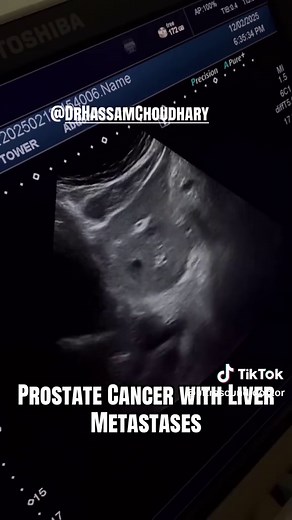 Prostate Cancer with Liver Metastases | Ultrasound Appearance Prostate cancer most commonly metastasizes to the bones, but in advanced stages, tumor cells may spread through the bloodstream and involve visceral organs, including the liver. Hepatic metastasis is generally associated with a more aggressive disease course and poorer prognosis, making early recognition on imaging crucial. On ultrasound, liver metastases from prostate cancer can present with a variety of appearances, depending on tum