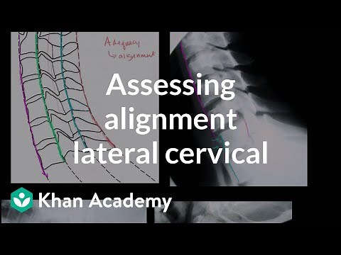 Assessing alignment of the lateral cervical spine (neck) X-ray | Heatlh & Medicine | Khan Academy