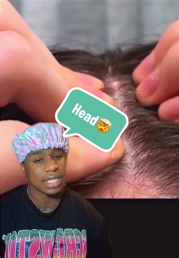 Pimple on the head reaction! #pimple #pimples #pimplepopping #pimplepopper #acne