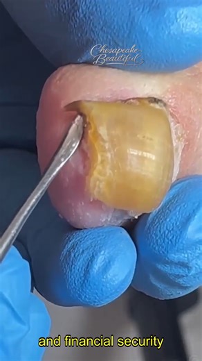 67K views · 217 reactions | Safe Ways to Manage Toenail Splitting #NailSplitting #HomeRemedies | Chesapeake Beautiful | Facebook