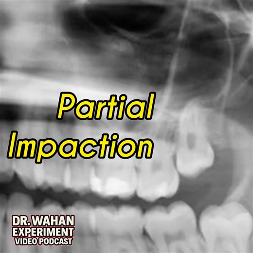 Upper Wisdom Tooth Rolls Out