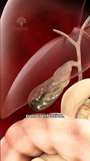Gallbladder removal surgery - Open Cholecystectomy #shorts #gallbladder - creativelearning3d