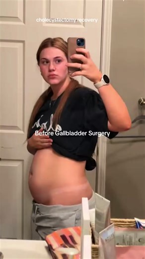 Gallbladder Surgery Recovery: My Life-Changing Journey