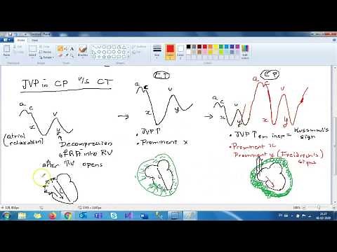 Constrictive pericarditis: Etiology and presentation