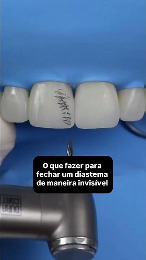 O que fazer para fechar um diastema de maneira invisível #dentista #odontologia