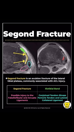 MSKMRI on Instagram: "📌Segond Fracture ✅ Segond Fracture A specific avulsion fracture on the lateral aspect of the proximal tibia, near the tibial plateau. Typically thin, ovoid, and vertically oriented, located anterolaterally or laterally along the lateral tibial plateau, posterior to Gerdy’s tubercle. References: [Skeletal Radiol (2016) 45:1635–1647], [Radiographics. 2016 Oct;36(6):1776-1791] ✅ Association with Anterolateral Ligament (ALL) and Other Ligamentous Injuries Indicative of anterol