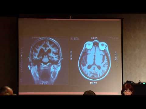 Treatment of and Research on Corticobasal Syndrome/Degeneration (CBS/CBD)