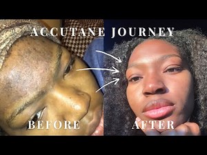 Accutane Changed My Skin FOREVER 😳 | Side Effects, Products & Before/After