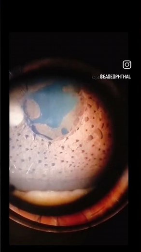 Iris nodules / peripheral synechiae and posterior synechiae