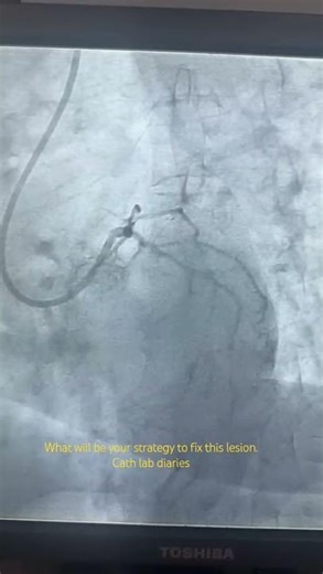 Cath lab diaries | Interventional Cardiology Cases | NSTEMI, what will be your strategy?