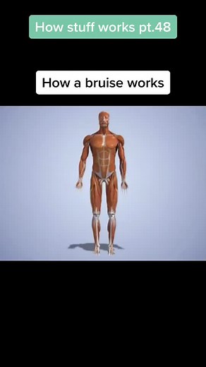 Understanding How Bruises Form