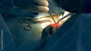 Surgery process held on a human organ by a team of surgeons