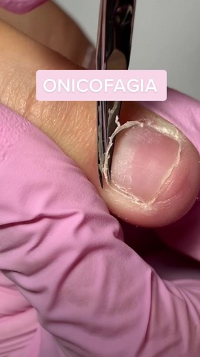 Onicofagia ancora e ancora #onicofagia#acrygelnails #ricostruzioneunghie #unghieinacrygel #acrygelchepassione #unghienuove #unghieconme #unghieconflavia #onicotecnicaetvoilà #flaviabaldes #baldesnails #trasformationnails #shortnails #blacknails