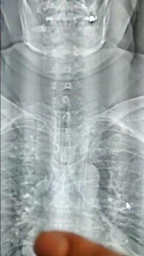 CT Soft tissue neck- anatomy to include