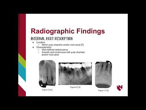 Internal or External Root Resorption