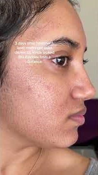 results of my fraxel laser treamtent for acne scars & large pores #skincare