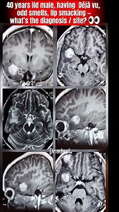 Can You Diagnose This From MRI? 🧠👀 MRI shows a temporal lobe space-occupying lesion. The patient experiences déjà vu, abnormal smells, and lip smacking episodes. 🧠 Can you identify the site of lesion before the reveal? Perfect for medical students, residents, radiology & neurology learners. Save • Share • Follow for quick clinical pearls. Neurology NeuroLab - Pearls in Neurosurgery, Neurology & Neuroradiology Radiology Verse Neurocirujano Miguel Á. Ramírez Sosa #temporallobe #brainlesion #mri
