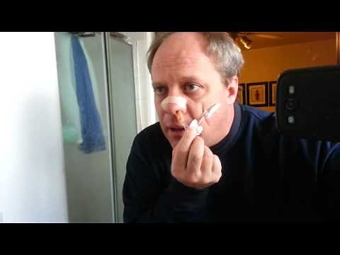 Rapid Rhino epistaxis nose pack removal