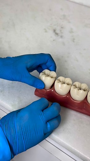 ¿Sabías que una caries puede comenzar con algo tan pequeño como una manchita? 👀 En este video te mostramos cómo evoluciona una caries y por qué es tan importante hacer controles regulares. Visitar al odontólogo cada 4 a 6 meses permite detectar cualquier problema a tiempo y evitar que avance hasta el nervio. ✨ La prevención es la clave para mantener una sonrisa sana y evitar tratamientos más complejos. 📍Batlle y Ordóñez 876 casi Mata 📲 Agenda tu control hoy mismo | Dra. Eliana González - Orto