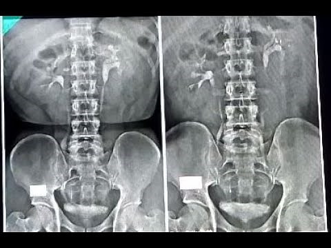 IVU (Intravanous urography) Radiography. বাংলা ভাষা.