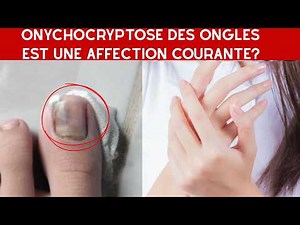 Is onychocryptosis of the nails a common condition?