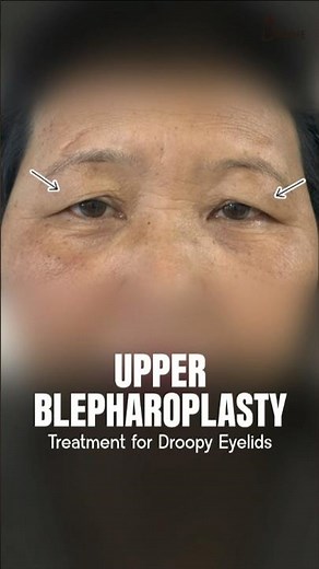 Upper Blepharoplasty for Droopy Eyelids | Eyelid Surgery Procedure & Results