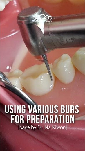 Using Various Burs for Preparation #dentalbean