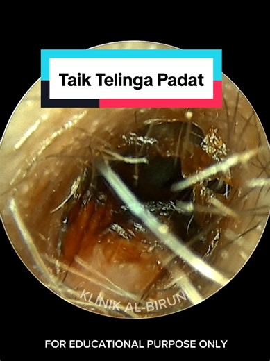 Taik telinga padat #telingatersumbat #cucitelinga #earwaxremoval #satisfying #klinikalbiruni