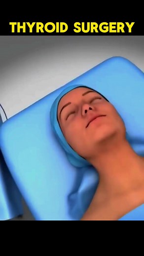 Transoral endoscopic thyroidectomy vestibular approach (thyroid surgery) 3d animation #transoral #endoscopic #thyroidectomy #vestibular #approach #thyroid #thyroidproblems #thyroidsurgery #3dmedicalanimation