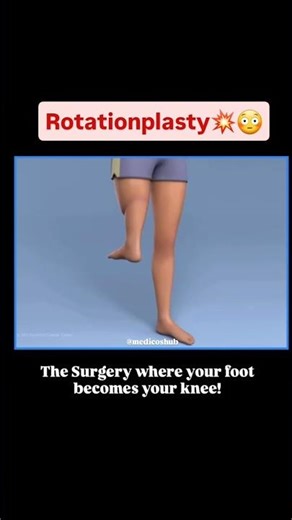 Rotationplasty | 180° Leg Rotation Surgery for Bone Cancer #shorts #rotationplasty #osteosarcoma #yt